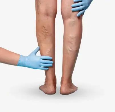 https://vedakare-assets.s3.ap-south-1.amazonaws.com/Treatment/varicose-venis.webp